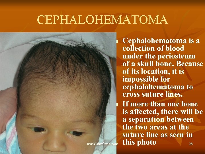 CEPHALOHEMATOMA n n www. similima. com Cephalohematoma is a collection of blood under the