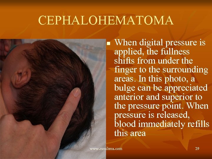 CEPHALOHEMATOMA n When digital pressure is applied, the fullness shifts from under the finger