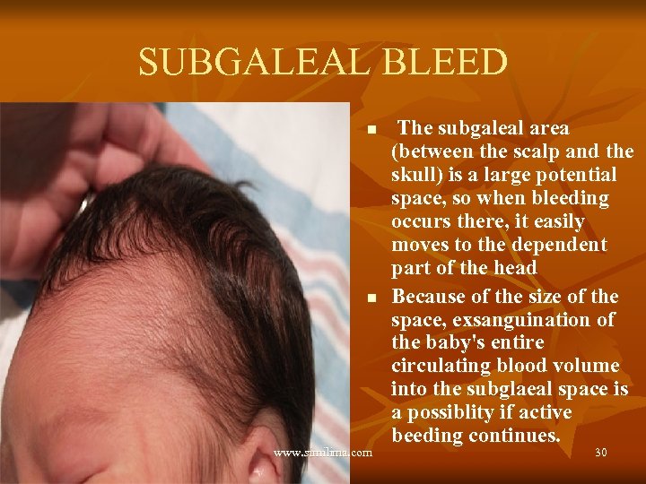 SUBGALEAL BLEED n n www. similima. com The subgaleal area (between the scalp and