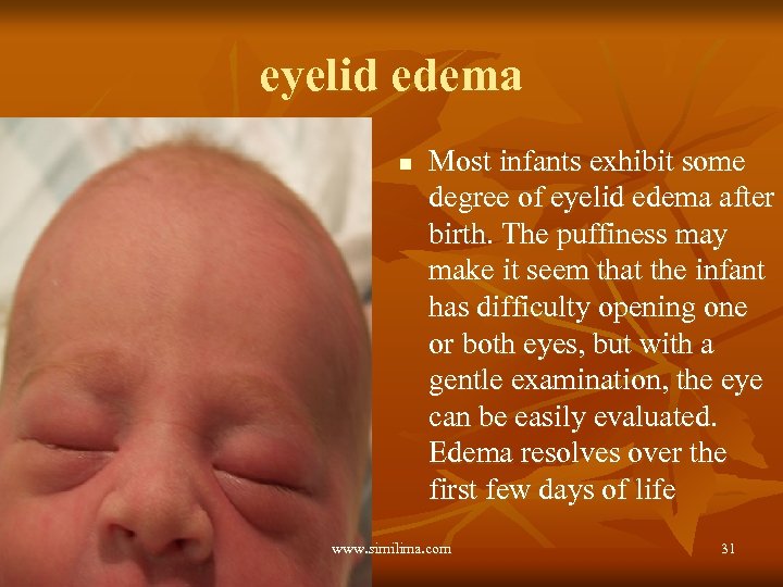 eyelid edema n Most infants exhibit some degree of eyelid edema after birth. The