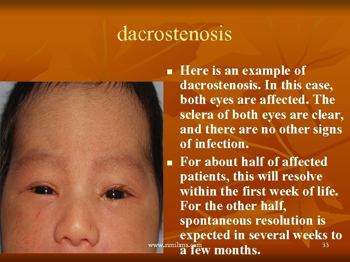 dacrostenosis Here is an example of dacrostenosis. In this case, both eyes are affected.