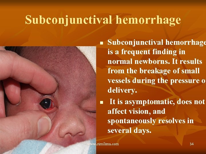 Subconjunctival hemorrhage n n Subconjunctival hemorrhage is a frequent finding in normal newborns. It