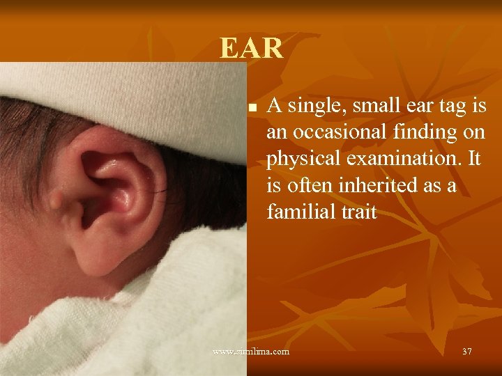 EAR n A single, small ear tag is an occasional finding on physical examination.
