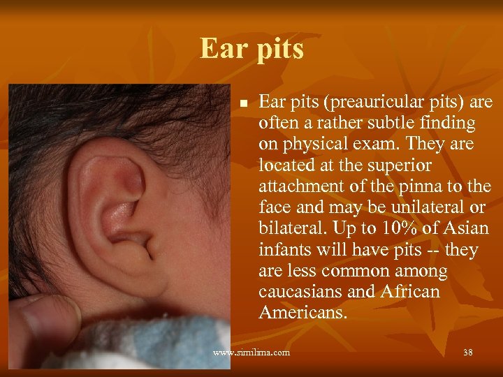 Ear pits n Ear pits (preauricular pits) are often a rather subtle finding on