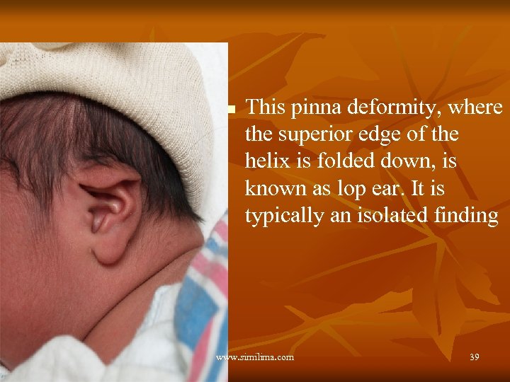 n This pinna deformity, where the superior edge of the helix is folded down,