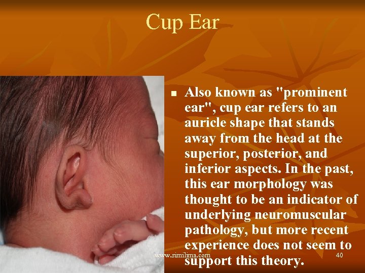 Cup Ear Also known as "prominent ear", cup ear refers to an auricle shape