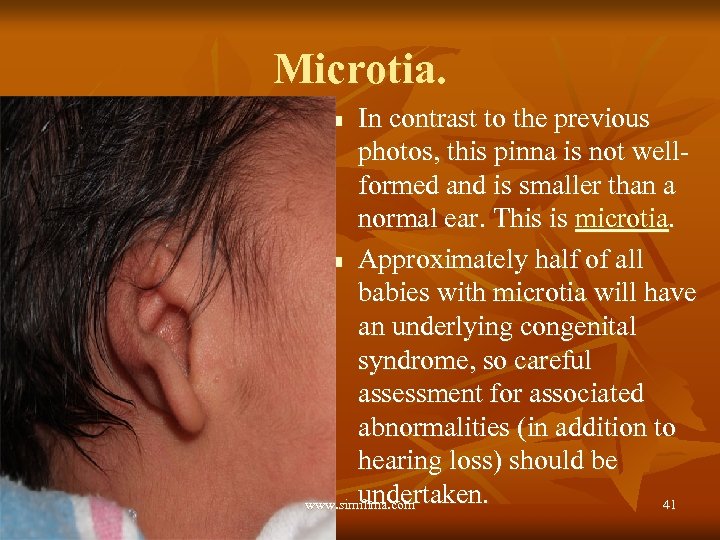 Microtia. In contrast to the previous photos, this pinna is not wellformed and is