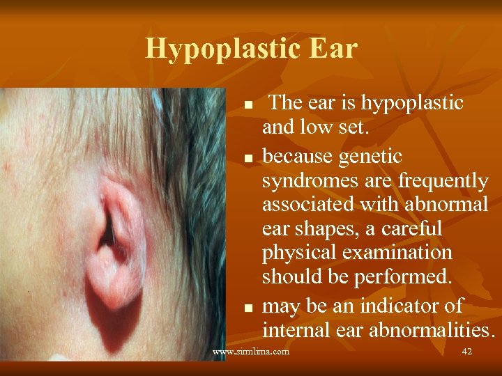 Hypoplastic Ear n n n The ear is hypoplastic and low set. because genetic