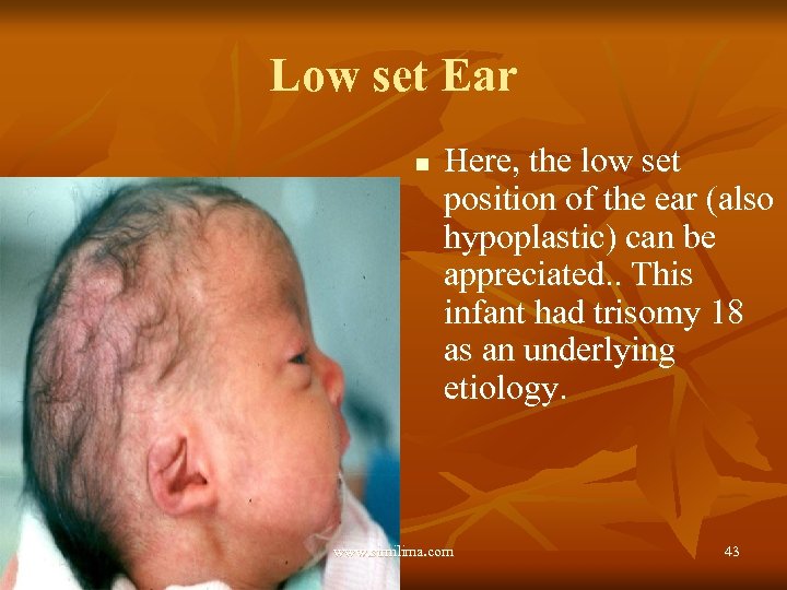 Low set Ear n Here, the low set position of the ear (also hypoplastic)