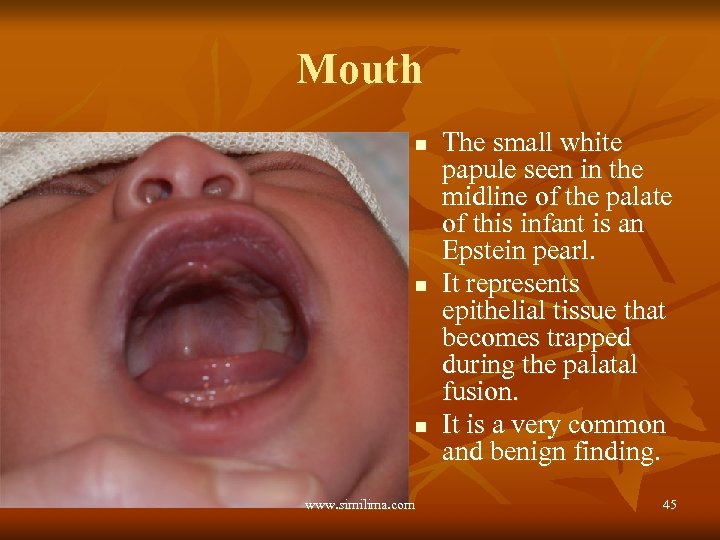 Mouth n n n www. similima. com The small white papule seen in the