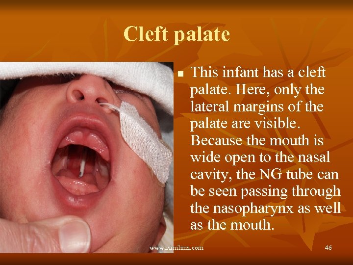 Cleft palate n This infant has a cleft palate. Here, only the lateral margins