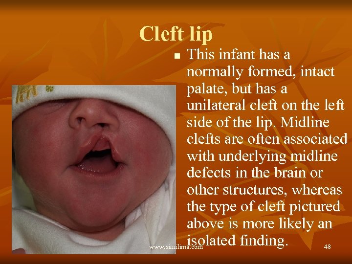 Cleft lip This infant has a normally formed, intact palate, but has a unilateral