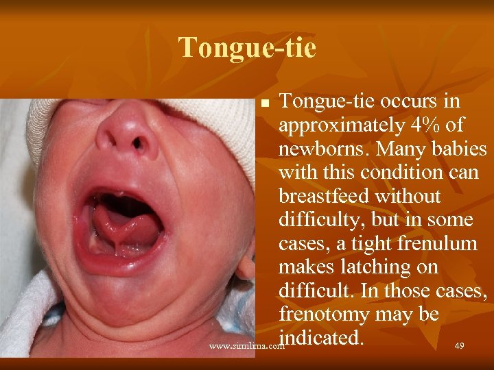 Tongue-tie occurs in approximately 4% of newborns. Many babies with this condition can breastfeed