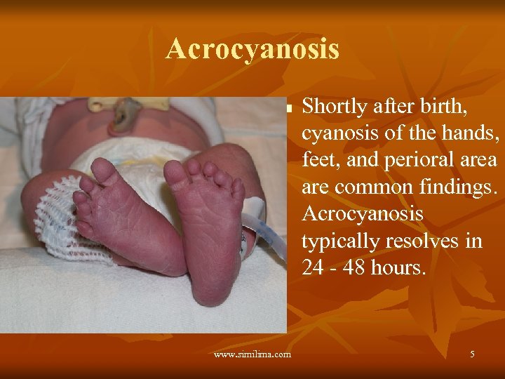 Acrocyanosis n www. similima. com Shortly after birth, cyanosis of the hands, feet, and