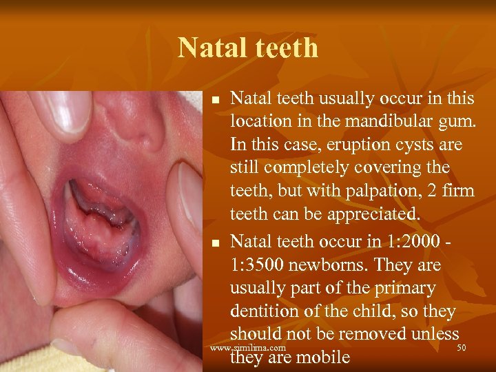 Natal teeth usually occur in this location in the mandibular gum. In this case,