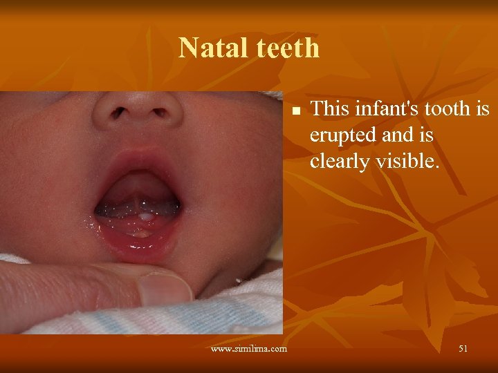 Natal teeth n www. similima. com This infant's tooth is erupted and is clearly