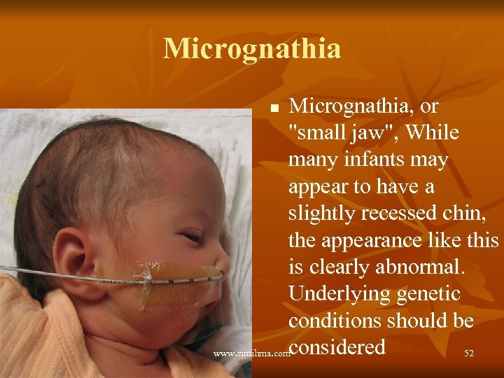 Micrognathia, or "small jaw", While many infants may appear to have a slightly recessed