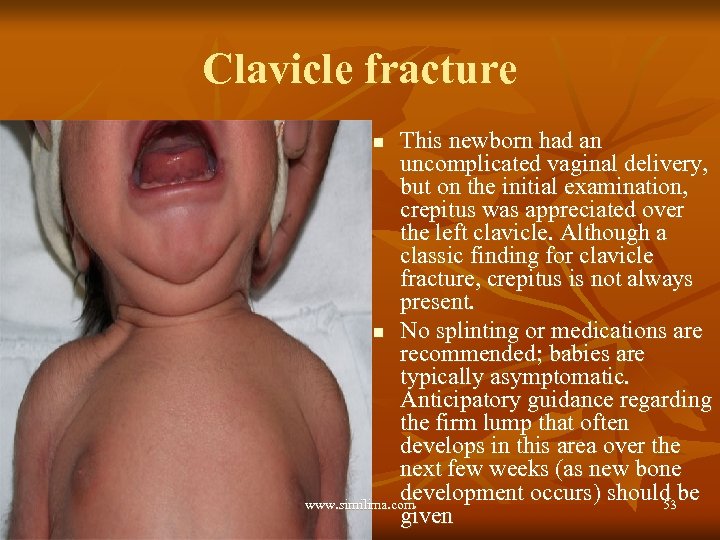 Clavicle fracture This newborn had an uncomplicated vaginal delivery, but on the initial examination,