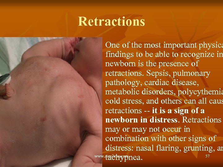 Retractions One of the most important physica findings to be able to recognize in