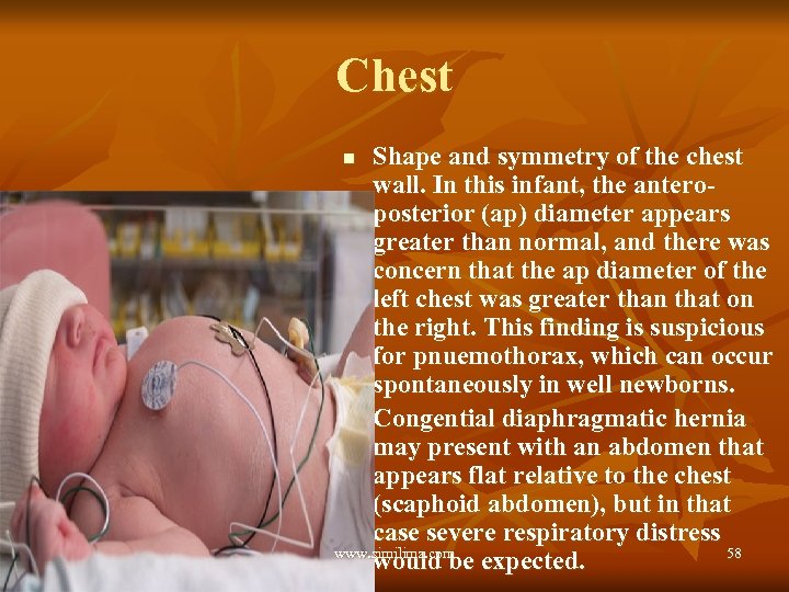 Chest Shape and symmetry of the chest wall. In this infant, the anteroposterior (ap)