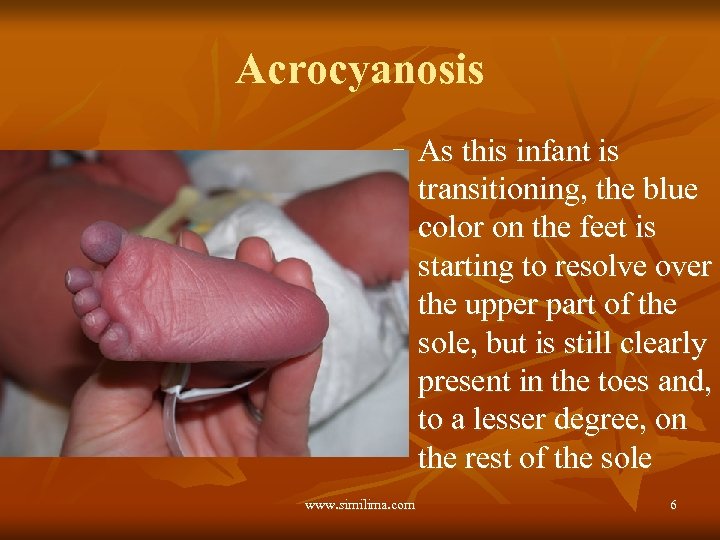 Acrocyanosis n www. similima. com As this infant is transitioning, the blue color on