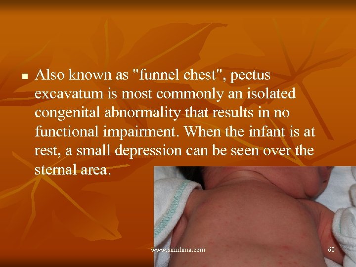 n Also known as "funnel chest", pectus excavatum is most commonly an isolated congenital