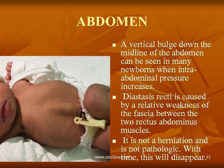 ABDOMEN A vertical bulge down the midline of the abdomen can be seen in