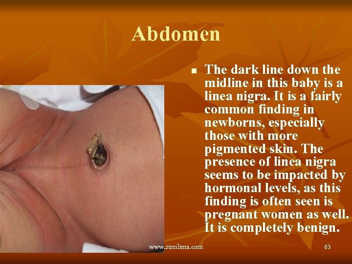Abdomen n www. similima. com The dark line down the midline in this baby