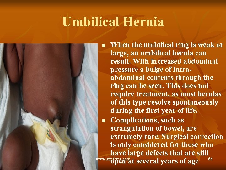 Umbilical Hernia When the umbilical ring is weak or large, an umbilical hernia can