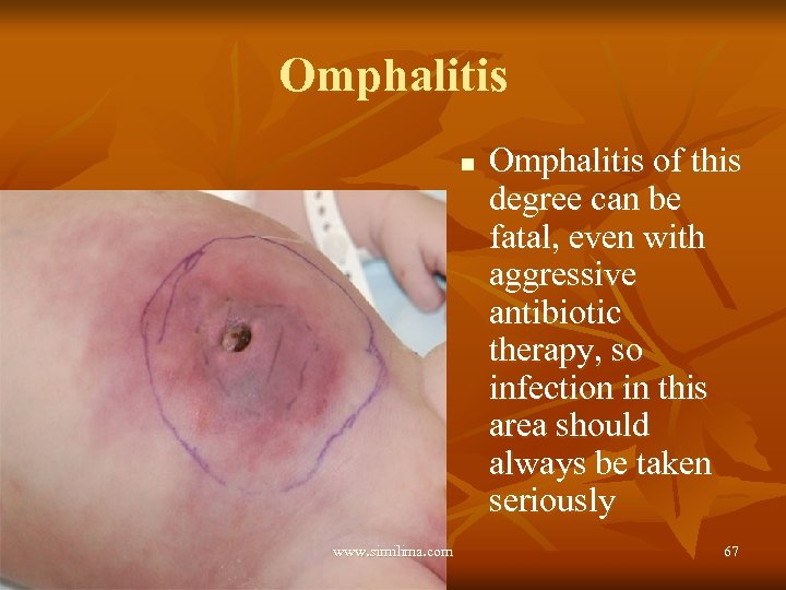 Omphalitis n www. similima. com Omphalitis of this degree can be fatal, even with