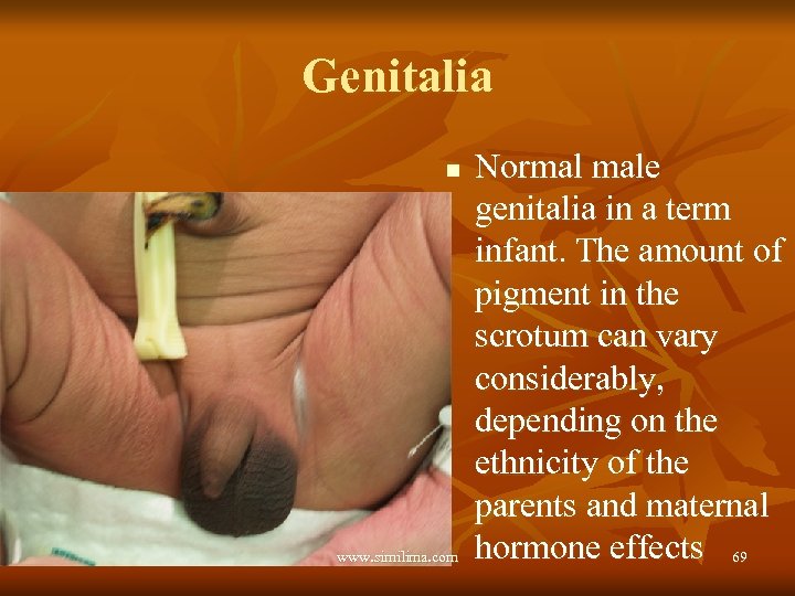 Genitalia n www. similima. com Normal male genitalia in a term infant. The amount