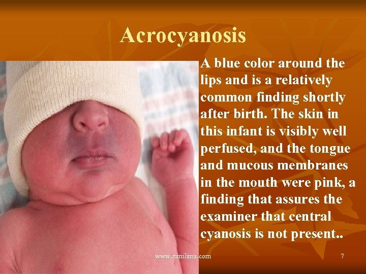 Acrocyanosis n A blue color around the lips and is a relatively common finding