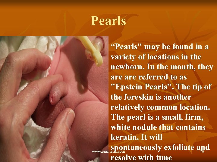 Pearls “Pearls" may be found in a variety of locations in the newborn. In
