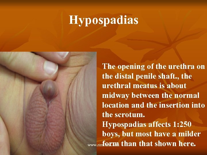 Hypospadias The opening of the urethra on the distal penile shaft. , the urethral