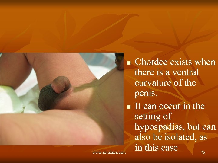 n n www. similima. com Chordee exists when there is a ventral curvature of