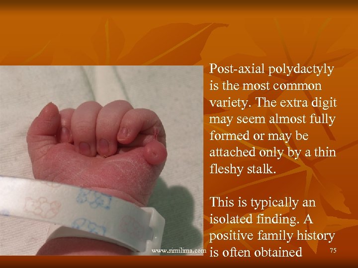 Post-axial polydactyly is the most common variety. The extra digit may seem almost fully