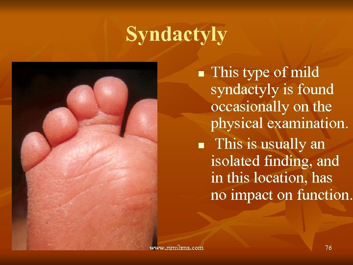 Syndactyly n n www. similima. com This type of mild syndactyly is found occasionally