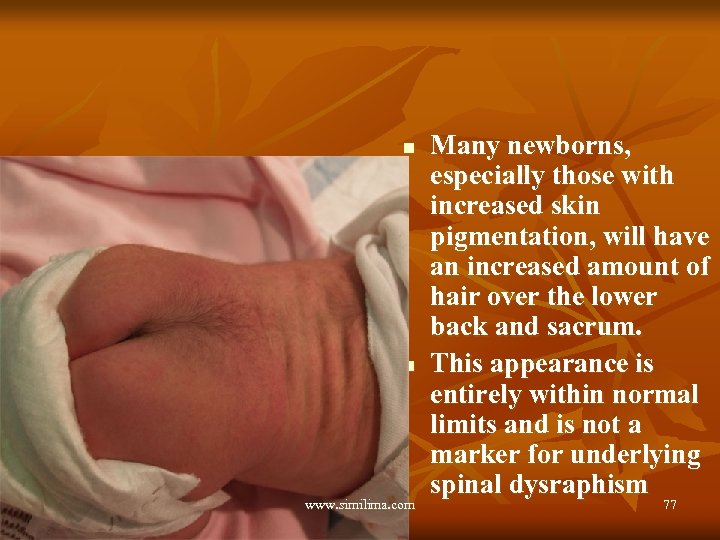 n n www. similima. com Many newborns, especially those with increased skin pigmentation, will
