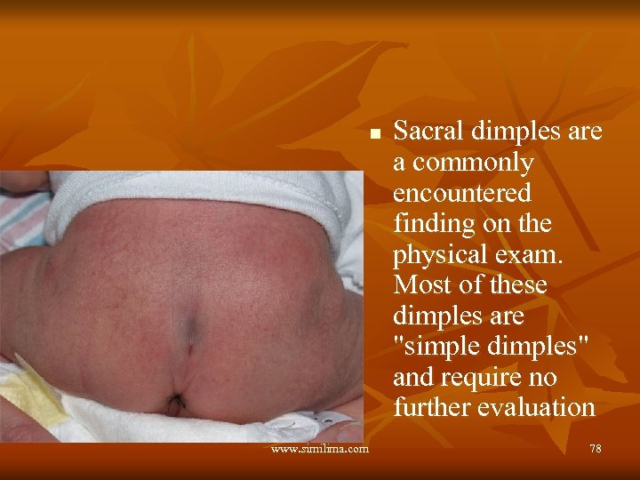 n www. similima. com Sacral dimples are a commonly encountered finding on the physical