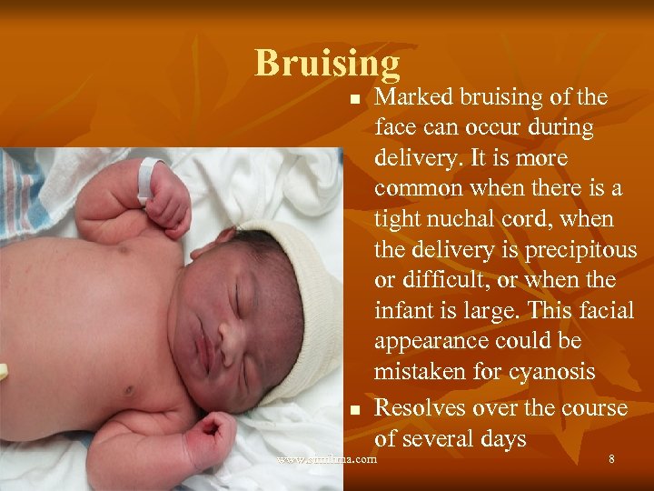 Bruising n n Marked bruising of the face can occur during delivery. It is