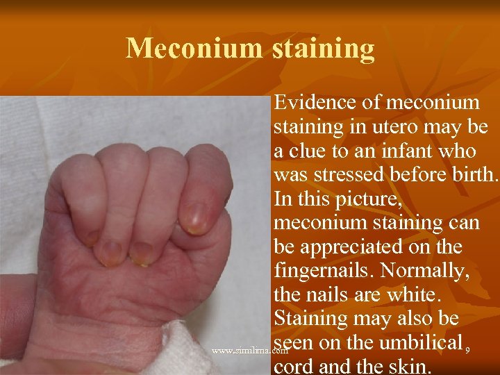 Meconium staining Evidence of meconium staining in utero may be a clue to an