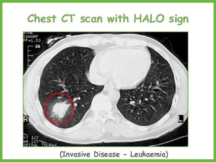 Chest CT scan with HALO sign (Invasive Disease - Leukaemia) 