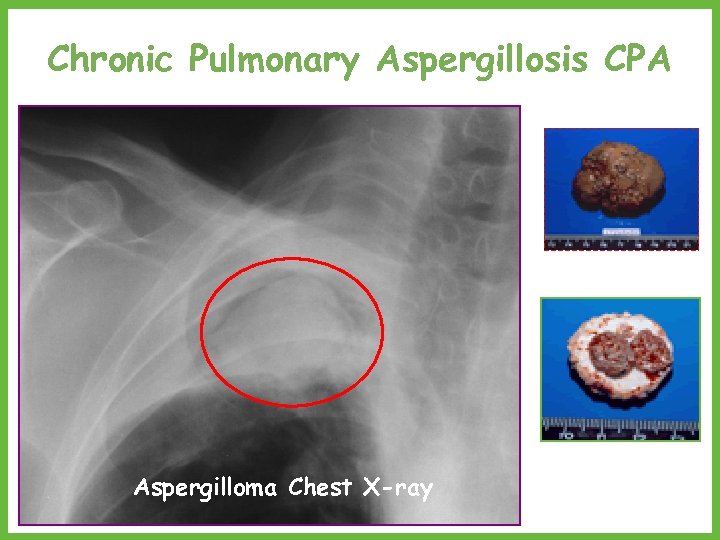 Chronic Pulmonary Aspergillosis CPA Aspergilloma Chest X-ray 