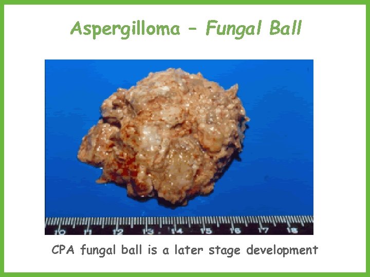 Aspergilloma – Fungal Ball CPA fungal ball is a later stage development 