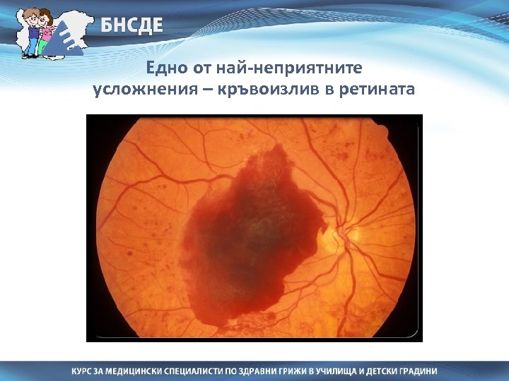 Едно от най-неприятните усложнения – кръвоизлив в ретината 