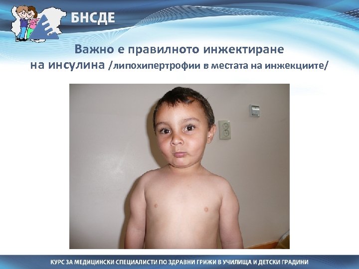 Важно е правилното инжектиране на инсулина /липохипертрофии в местата на инжекциите/ 