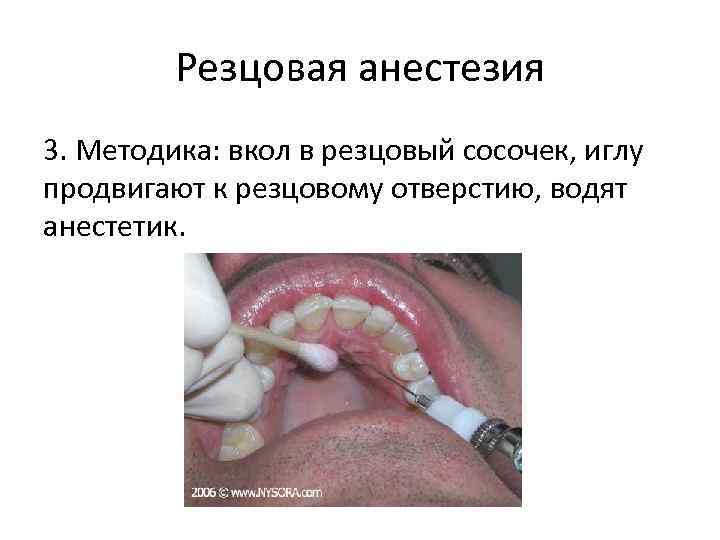 Резцовая анестезия 3. Методика: вкол в резцовый сосочек, иглу продвигают к резцовому отверстию, водят