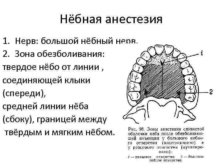 Нёбная анестезия 1. Нерв: большой нёбный нерв. 2. Зона обезболивания: твердое нёбо от линии