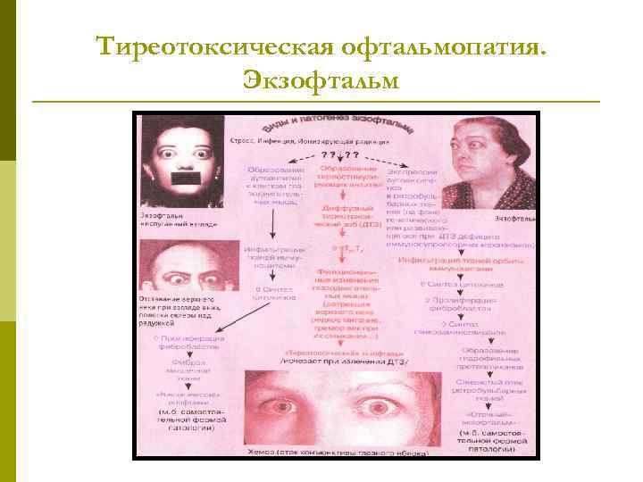 Тиреотоксическая офтальмопатия. Экзофтальм 
