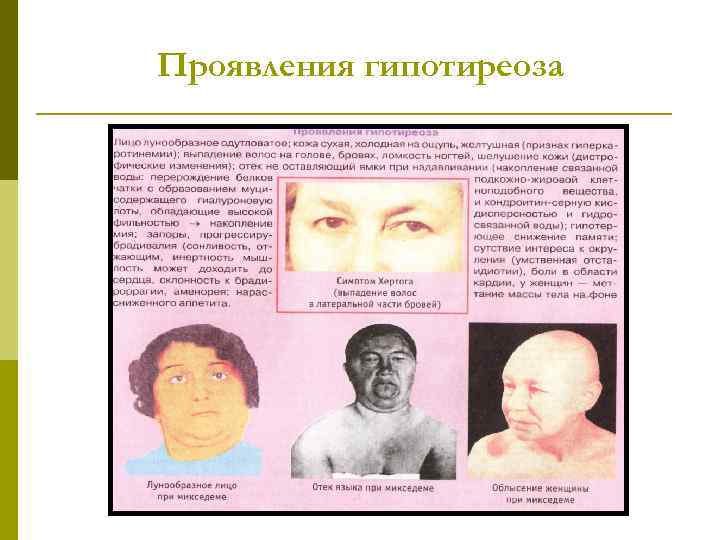 Проявления гипотиреоза 